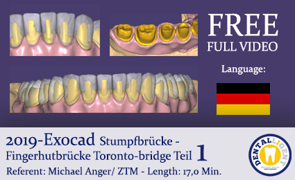 Artikelbild 1 des Artikels “2019 FREE FULL TUTORIAL - EXOCAD - TORONTO-BRIDGE - Fingerhutbrücke “