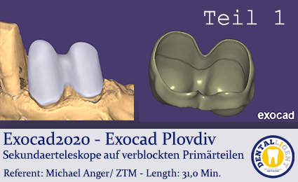 Artikelbild 1 des Artikels “2020-Exocad - Exocad Plovdiv - Sekundaerteleskope auf verblockten Primärteilen - Teil1 “