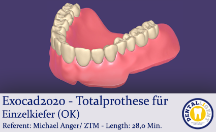 Artikelbild 1 des Artikels “2020-Exocad - Exocad-Plovdiv – Totalprothese für Einzelkiefer (OK) “