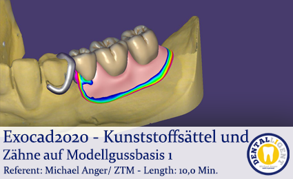 Artikelbild 1 des Artikels “2020-Exocad - Exocad-Plovdiv – Kunststoffsättel und Zähne auf Modellgussbasis Teil 1 “