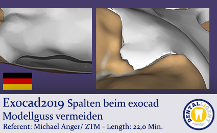 Artikelbild 1 des Artikels “2019-Exocad - Spalten beim exocad Modellguss vermeiden   “
