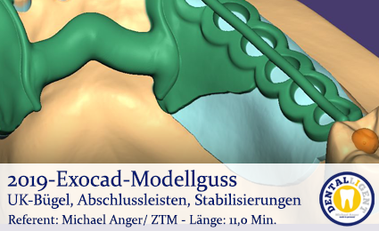 Artikelbild 1 des Artikels “2019-Exocad Modellguss UK-Bügel, Abschlussleisten, Stabilisierungen “