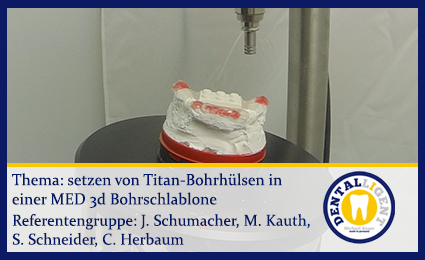 Product image 1 of the product “setzen von Titan-Bohrhülsen in einer MED-3D Bohrschablone ”