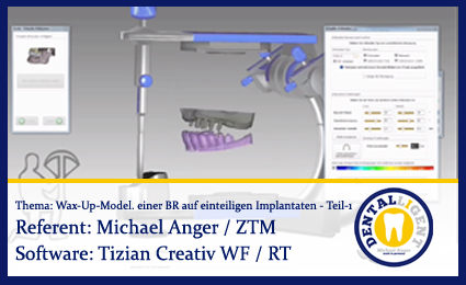 Product image 1 of the product “Wax-Up-Modellation einer Brücke auf einteiligen Implantaten - Teil 1 ”