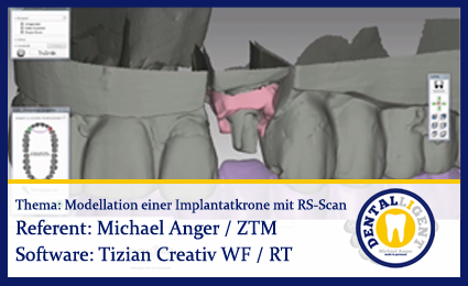 Artikelbild 1 des Artikels “Modellation einer Implantatkrone mit Renishaw-Scan “