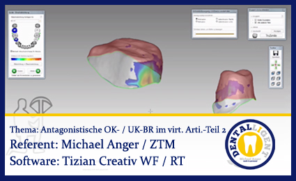 Artikelbild 1 des Artikels “Modellation von antagonistischen OK- und UK-Brücken im virtuellen Artikulator - Teil 2 “