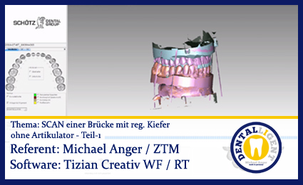 Product image 1 of the product “Scan einer Brücke mit reg. Kiefer ohne Artikulator Teil 1 ”