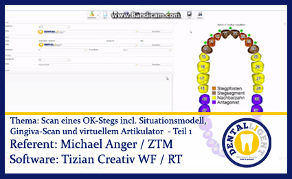 Artikelbild 1 des Artikels “Scan eines OK-Stegs incl. Situ / Gingiva-Scan und virt. Arti. Teil 1 “