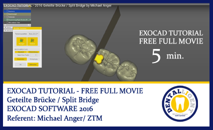 Artikelbild 1 des Artikels “2016-FREE FULL EXOCAD SUPPORT-Video - About: Geteilte Brücke “