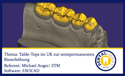 Artikelbild 1 des Artikels “2016-EXOCAD TUTORIAL - TABLE TOPS  im UK zur semipermanenten Bisserhöhung “