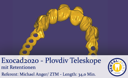Artikelbild 1 des Artikels “2020-Exocad - Exocad-Plovdiv - Teleskope mit Retentionen “