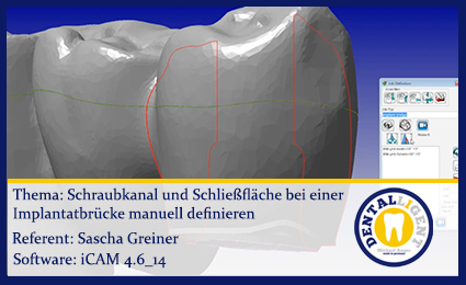 Product image 1 of the product “Schraubkanal und Schließfläche einer Implantatbrücke manuell definieren ”
