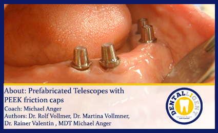 Product image 1 of the product “Topic: Prefabricated Telescopes with PEEK friction caps ”
