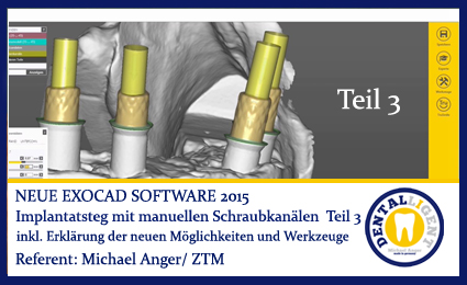 Product image 1 of the product “2016-Implantatsteg mit manueller Schraubkanalpositionierung Teil 3 - Exocad 2015 ”