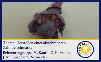 Product image of the product “Herstellen einer abnehmbaren Zahnfleischmaske ”