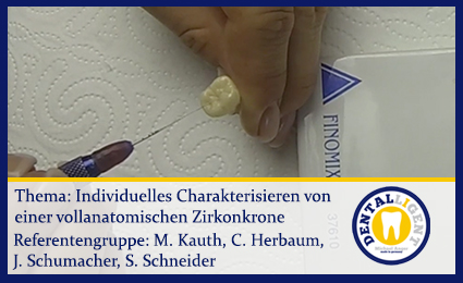 Product image of the product “individuelles Charakterisieren einer vollanatomischen Zirkonkrone ”