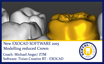 Artikelbild 1 des Artikels “2015-Modelling reduced Crown - Exocad 2015 “
