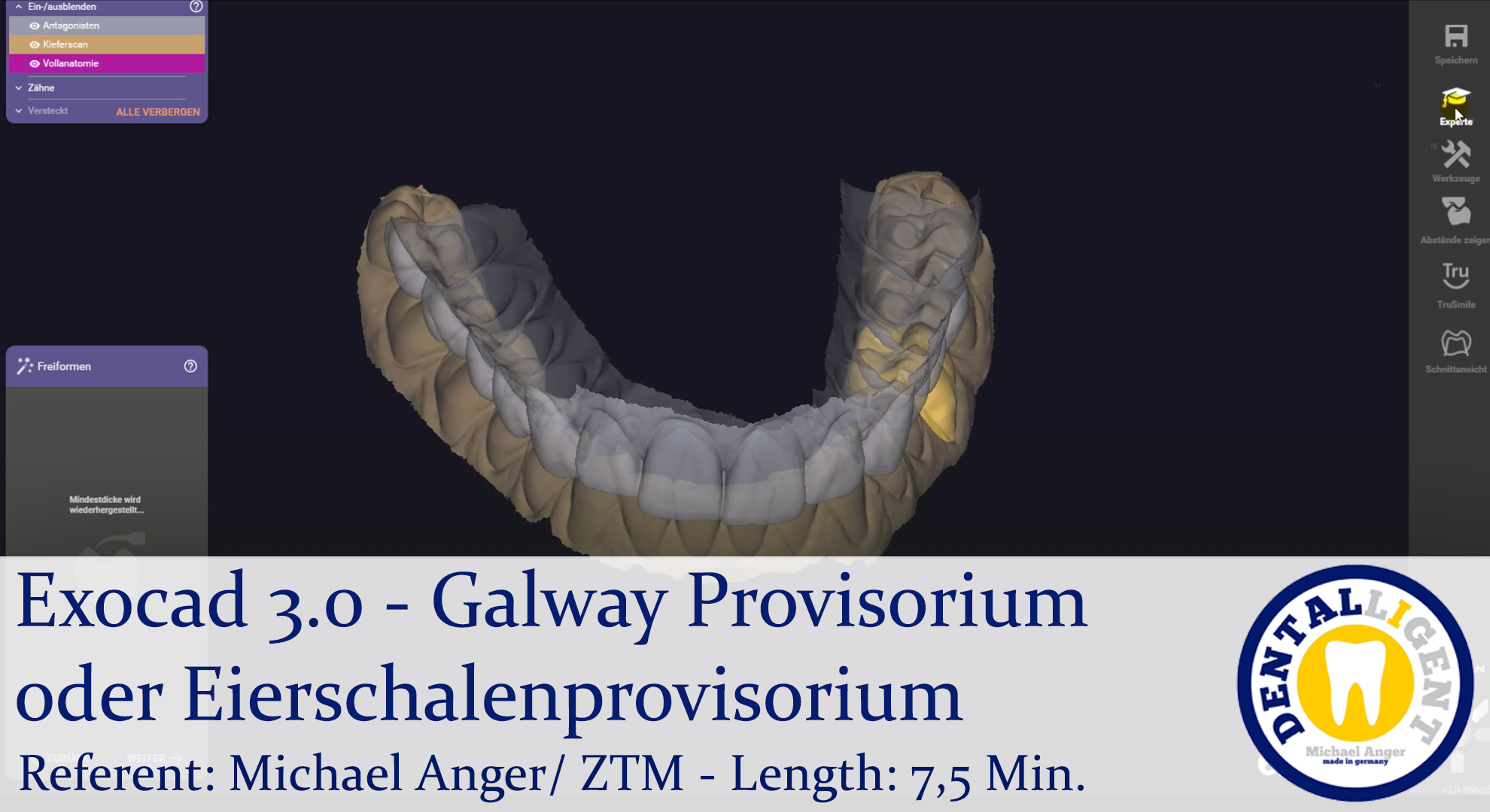 Artikelbild 1 des Artikels “2021-Exocad - Exocad 3.0 – Galway Provisorium oder Eierschalenprovisorium “