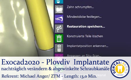 Product image 1 of the product “EXOCAD 2020 - GRATIS Video - Exocad Plovdiv - Implantate nachträglich verändern & abgewinkelte Schraubkanäle ”