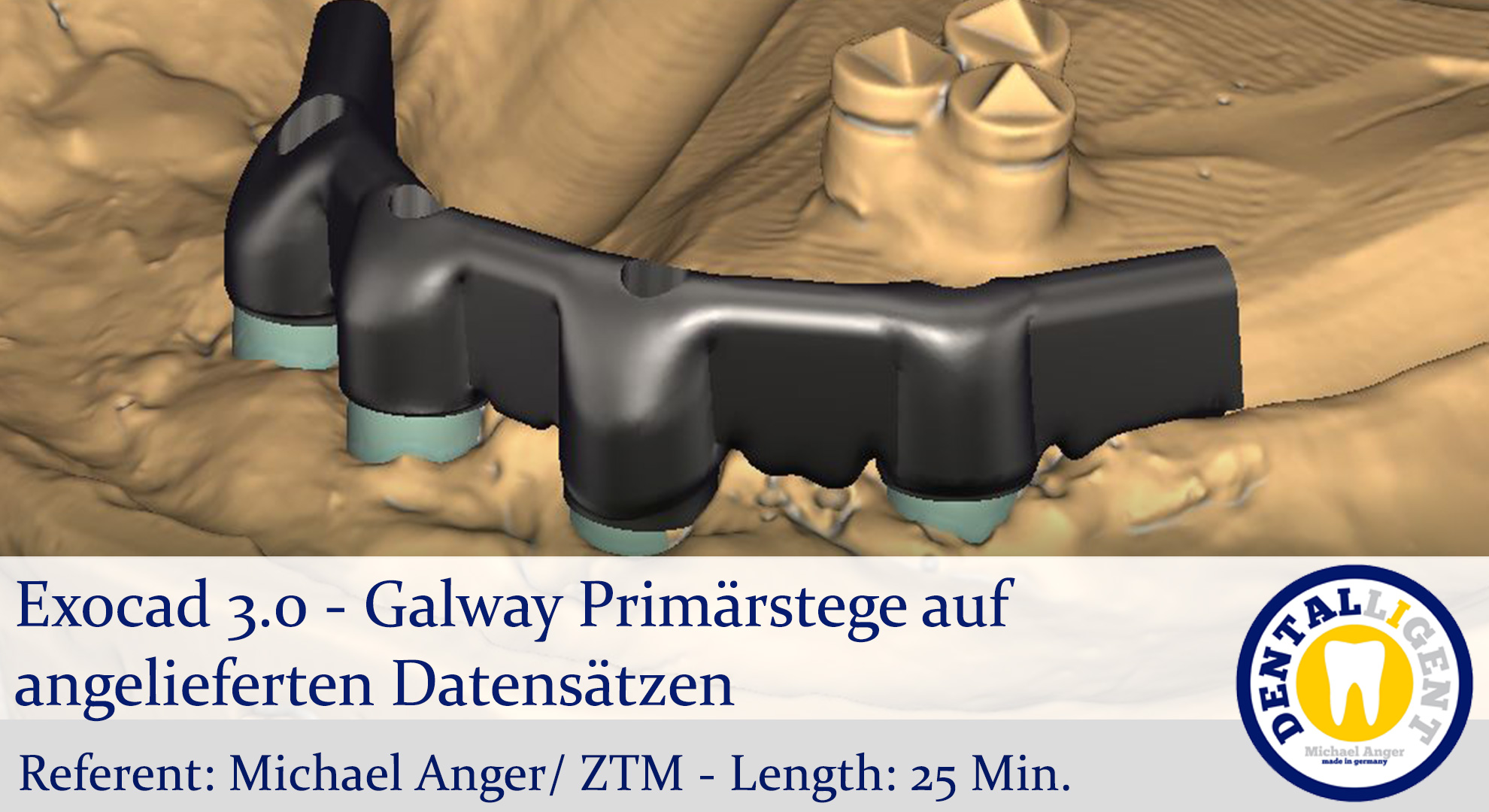 Artikelbild 1 des Artikels “2021-Exocad - Exocad 3.0 – Galway Primärstege auf angelieferten Datensätzen “