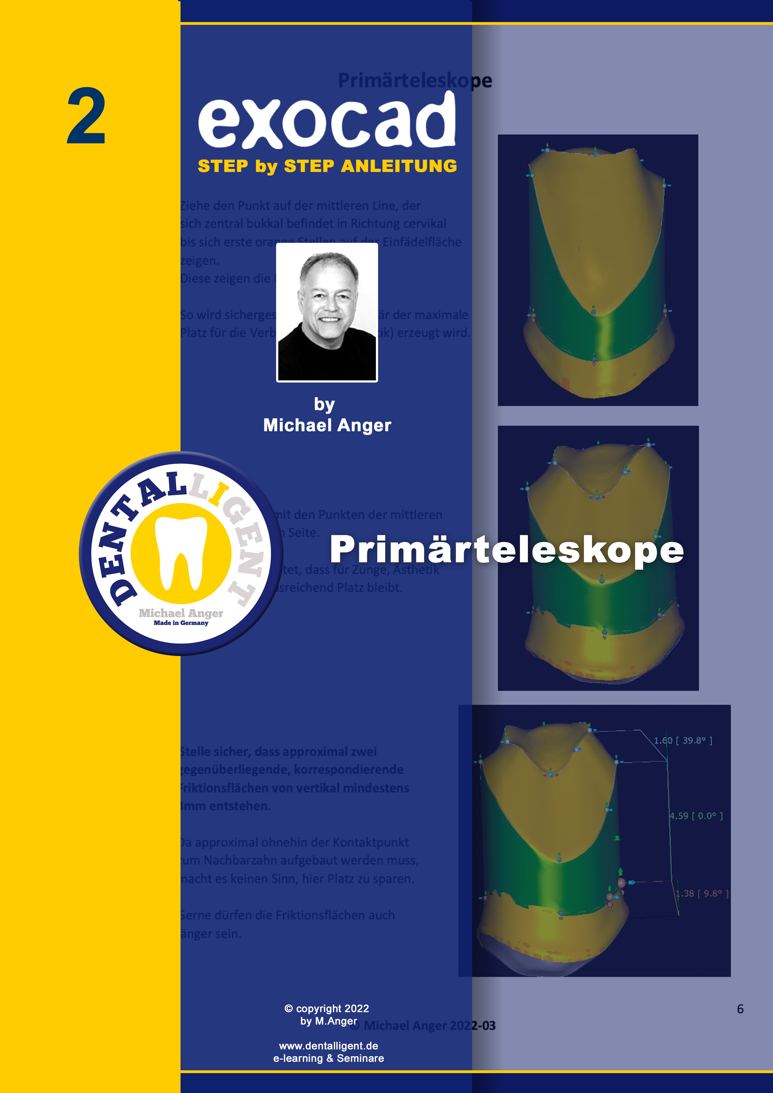 Product image 1 of the product “Exocad Step by Step Anleitung - Nr. 2 - Primärteleskope ”