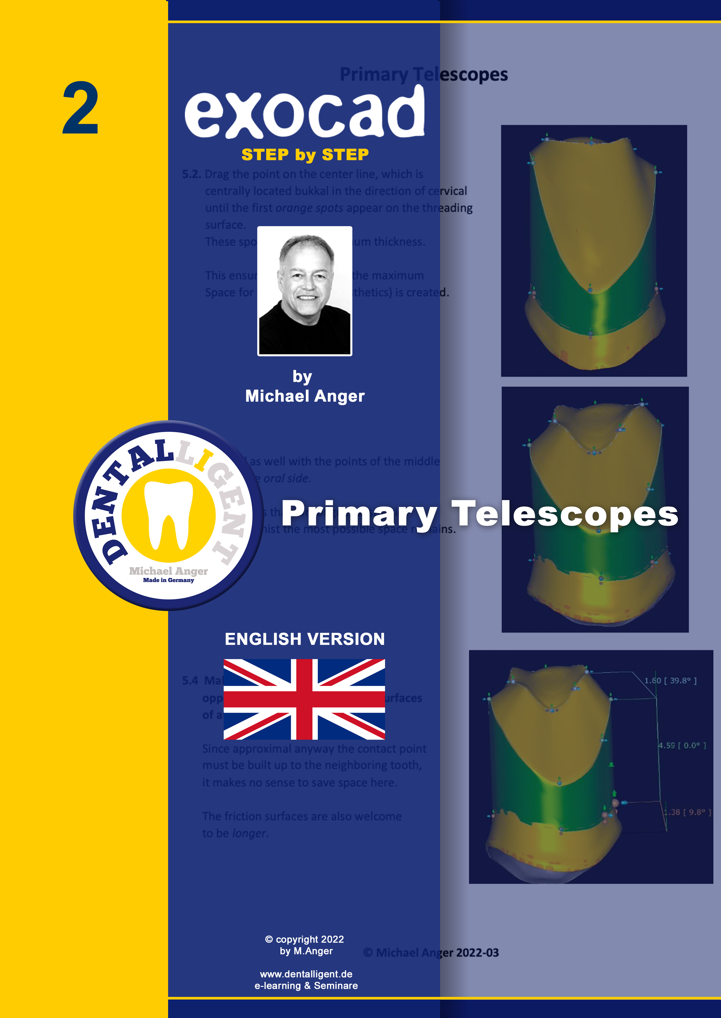 Artikelbild 1 des Artikels “Exocad Step by Step - Nr.2 -Primary Telescopes “