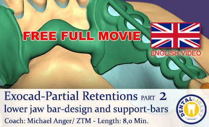 Product image 1 of the product “2019-FREE FULL TUTORIAL -Exocad-Partial lower jaw bar-design and support-bars ”