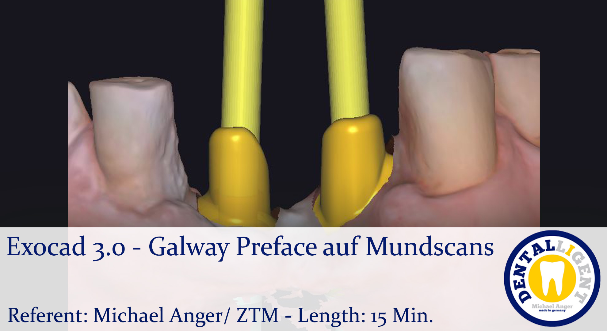 Artikelbild 1 des Artikels “2021-Exocad - Exocad 3.0 – Galway Preface auf Mundscans “