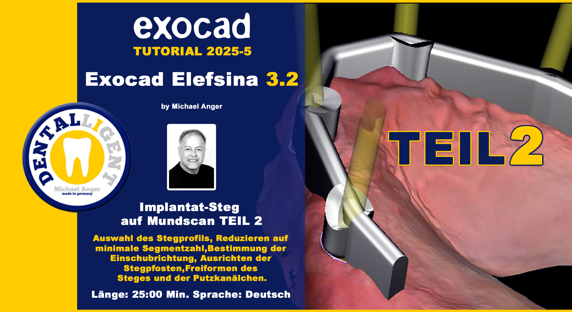 Artikelbild 1 des Artikels “Exocad Elefsina 3.2 - 2025-5 - Implantat Steg auf Mundscan Teil 2 “