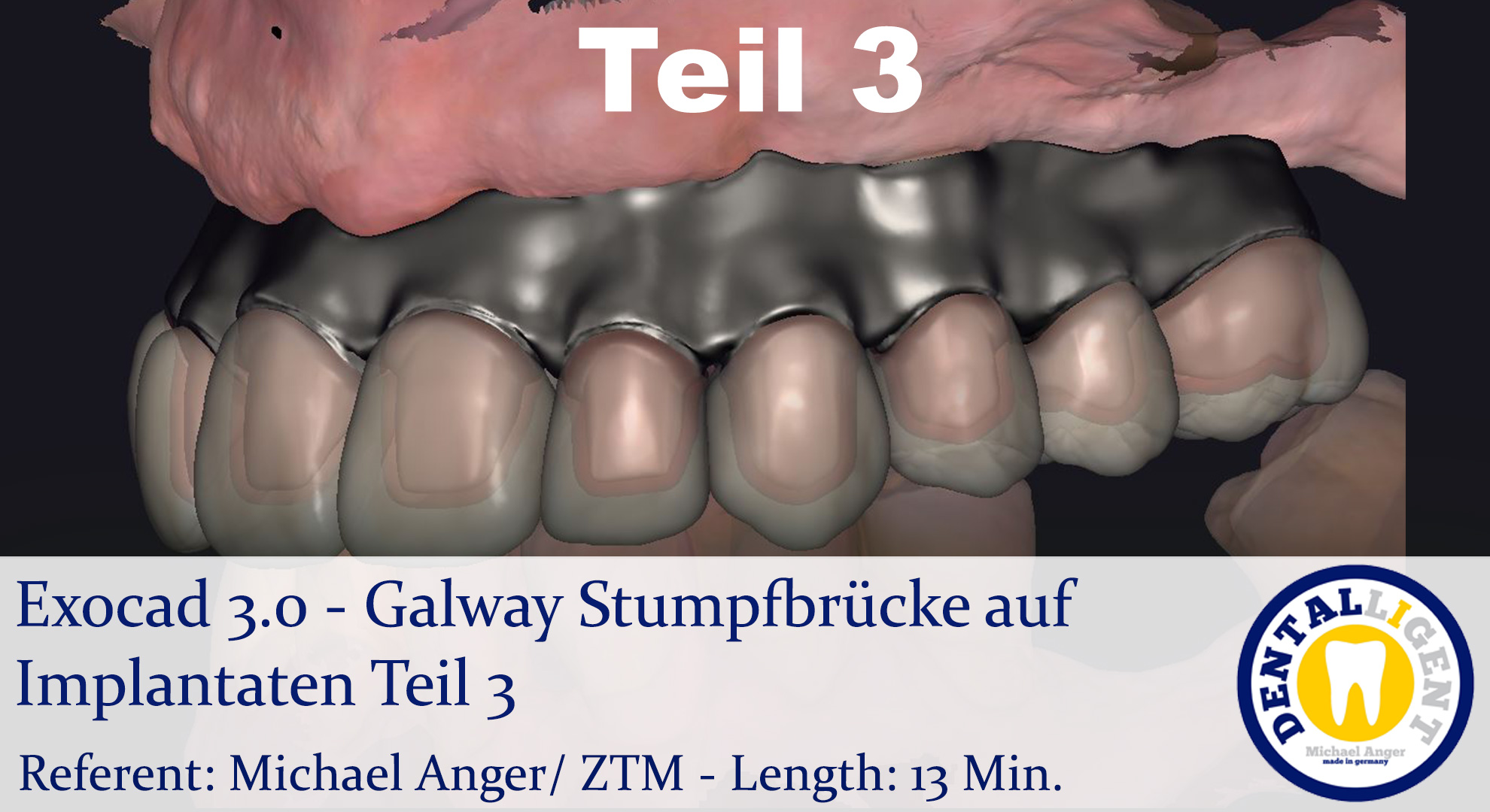 Product image 1 of the product “2021-Exocad 3.0 – Galway Stumpfbrücke auf Implantaten & Mundscan Teil 3 ”