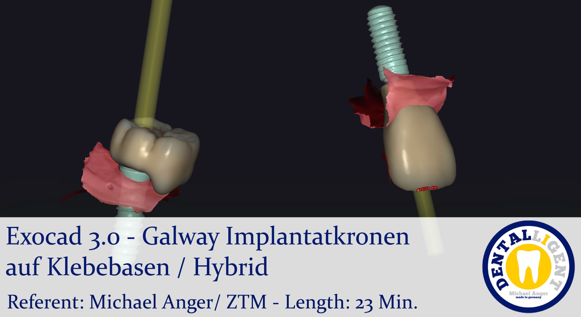 Artikelbild 1 des Artikels “2021-Exocad - Exocad 3.0 – Galway Galway Implantatkronen auf Klebebasen / Hybrid “