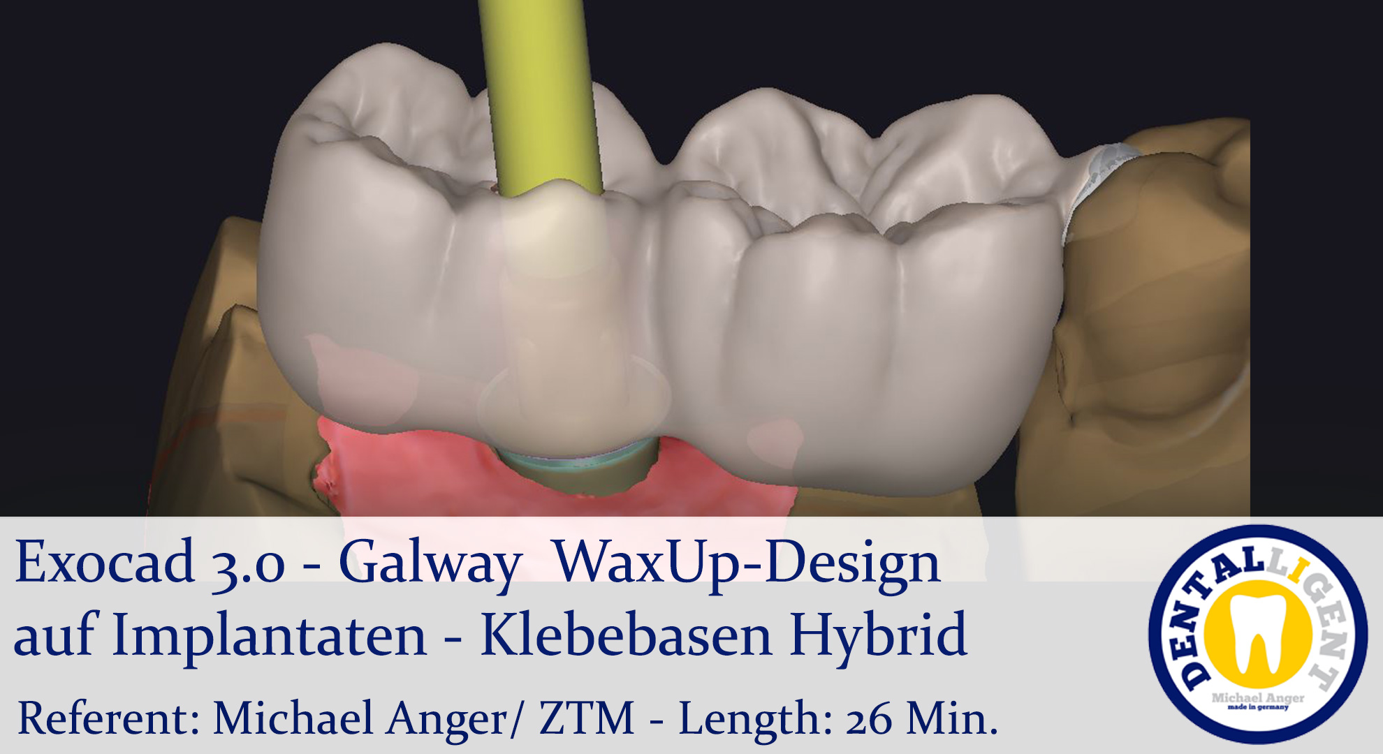Product image 1 of the product “2021-Exocad 3.0 – Galway WaxUp-Design auf Implantaten - Klebebasen Hybrid ”
