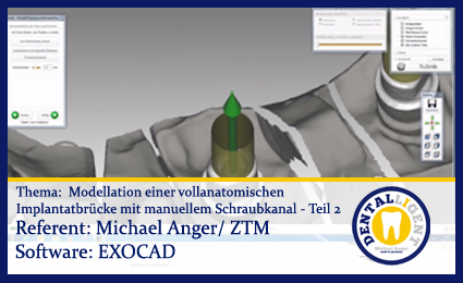 Artikelbild 1 des Artikels “Model. einer vollanat.Implantatbrücke mit man. Schraubkanal - Teil 2 “
