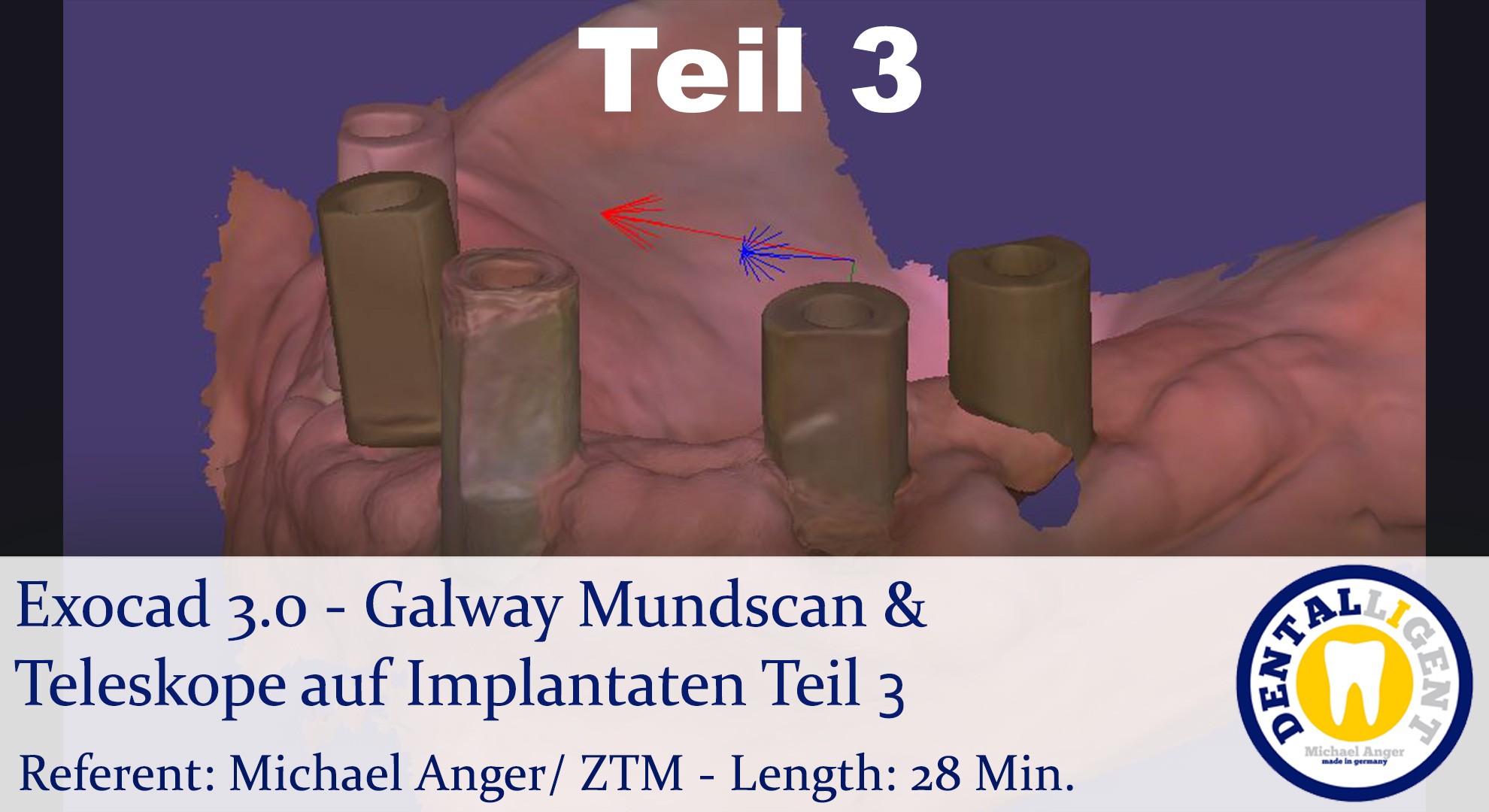 Product image 1 of the product “2021-Exocad 3.0 - Galway Mundscan & Teleskope auf Implantaten Teil3 ”