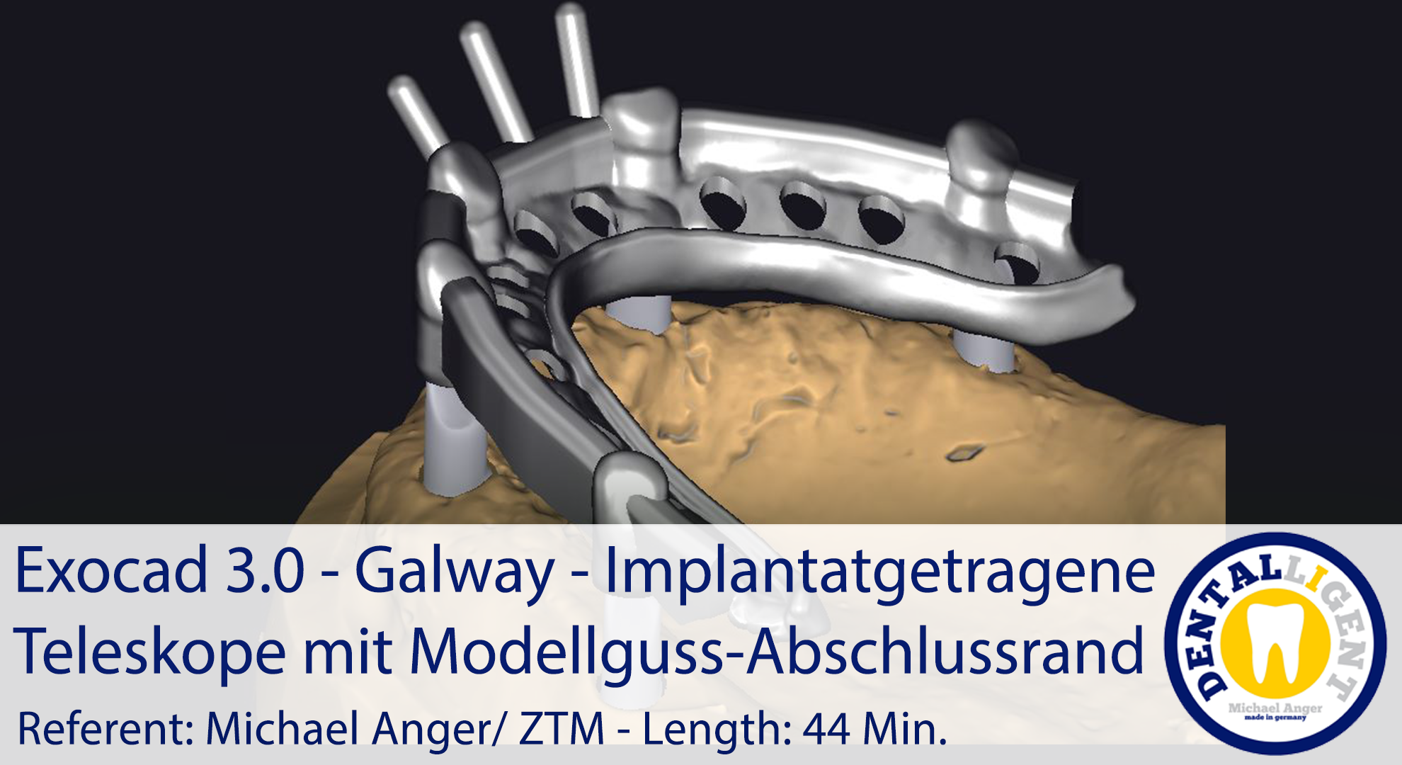 Product image 1 of the product “2021-Exocad 3.0 – Galway Implantatgetragene Teleskope mit Modellguss-Abschlussrand ”