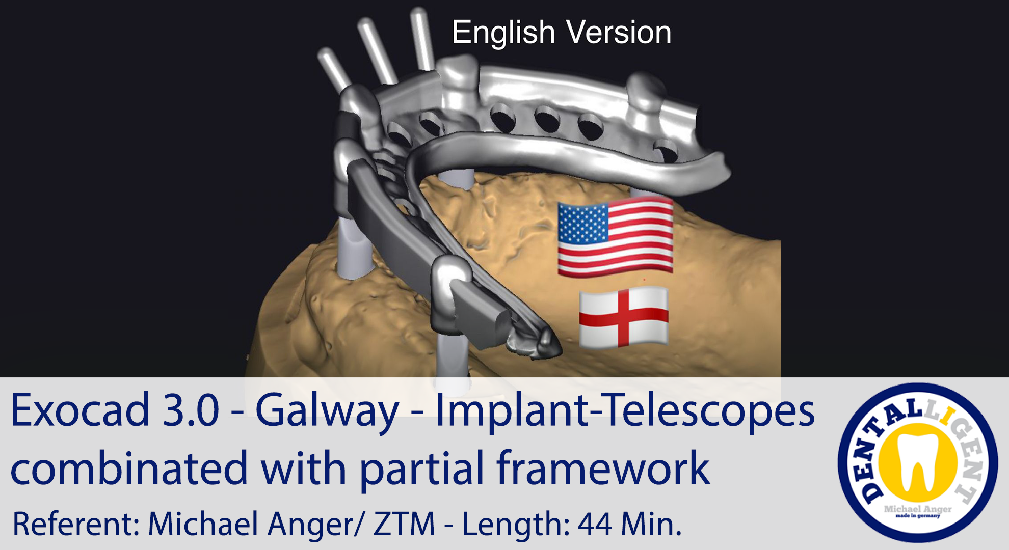 Artikelbild 1 des Artikels “2021-Exocad - Exocad 3.0 – Galway Implant-Telescopes combinated with partial framework “