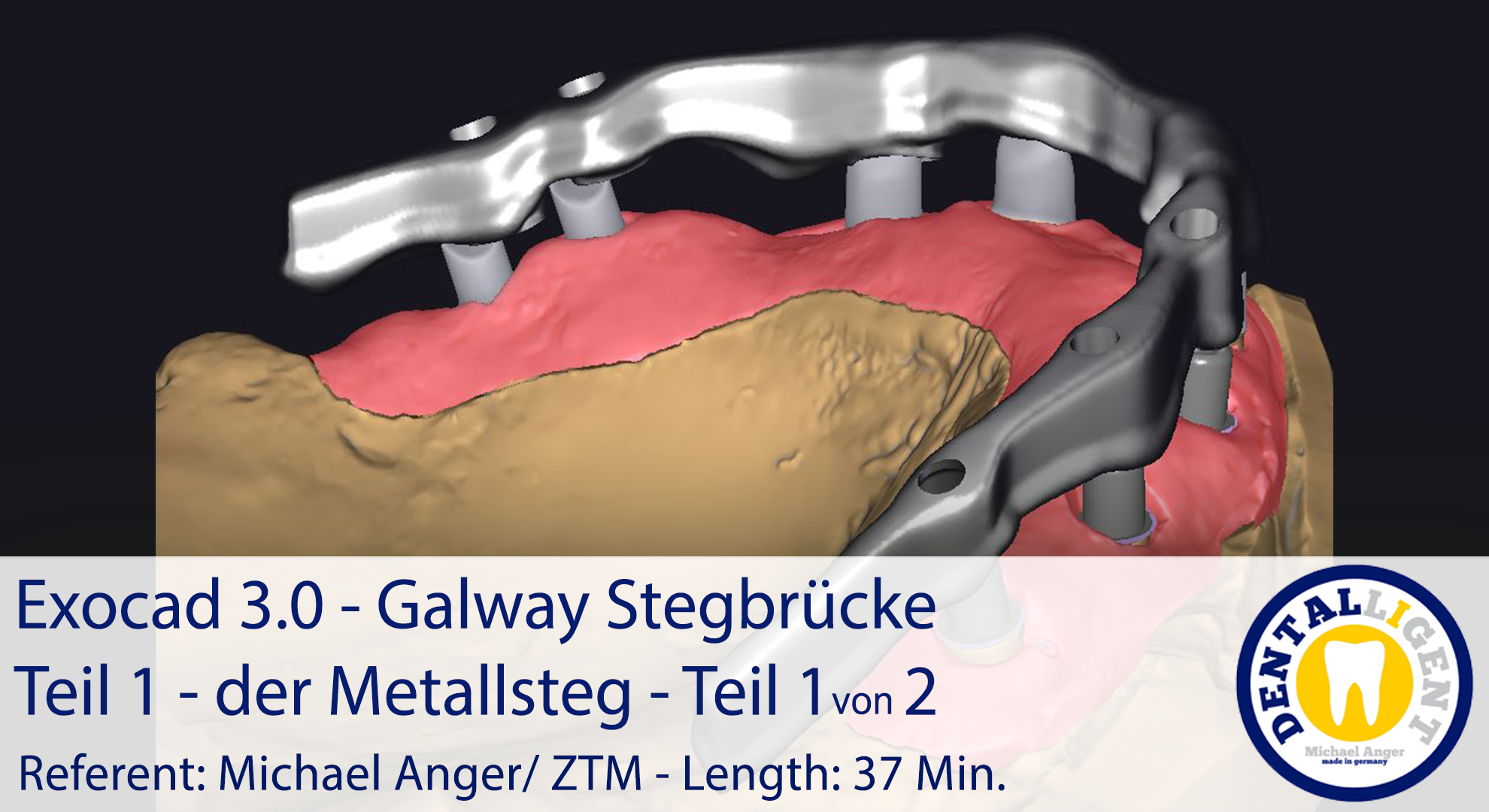 Artikelbild 1 des Artikels “2021-Exocad - Exocad 3.0 – Galway Stegbrücke Teil 1 - der Metallsteg - Teil 1 von 2 “