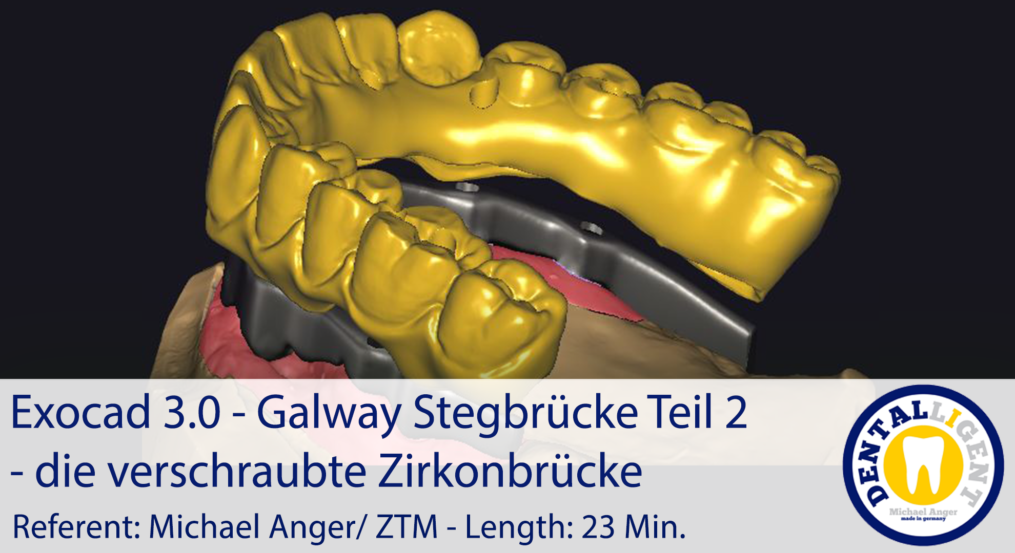 Artikelbild 1 des Artikels “2021-Exocad - Exocad 3.0 – Galway Stegbrücke Teil 2 - die verschraubte Zirkonbrücke “
