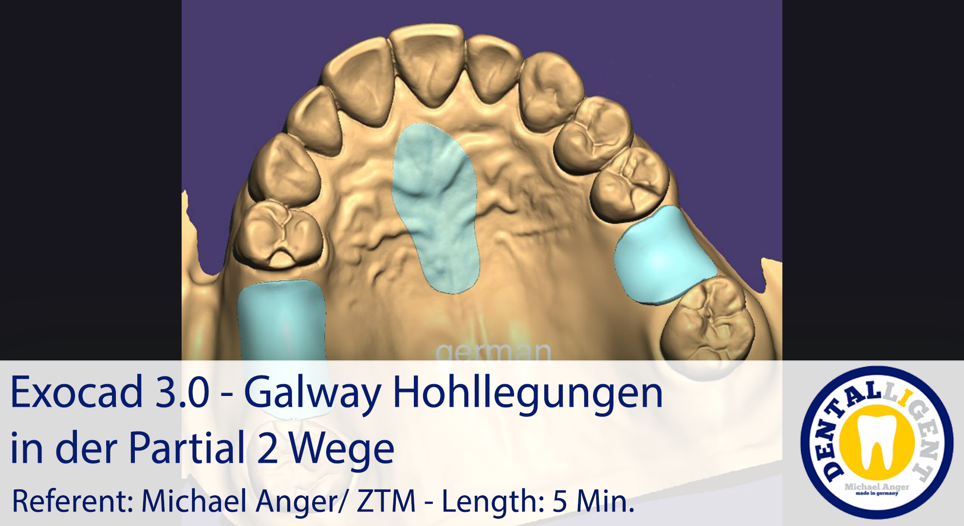 Product image 1 of the product “2021-Exocad 3.0 –  Galway Hohllegungen in der Partial 2 Wege ”