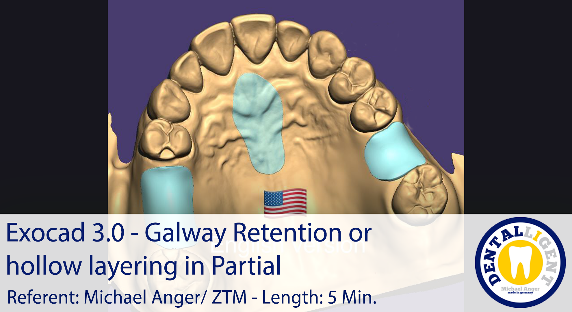 Artikelbild 1 des Artikels “2021-Exocad 3.0 – Galway Retention or hollow layering in Partial “