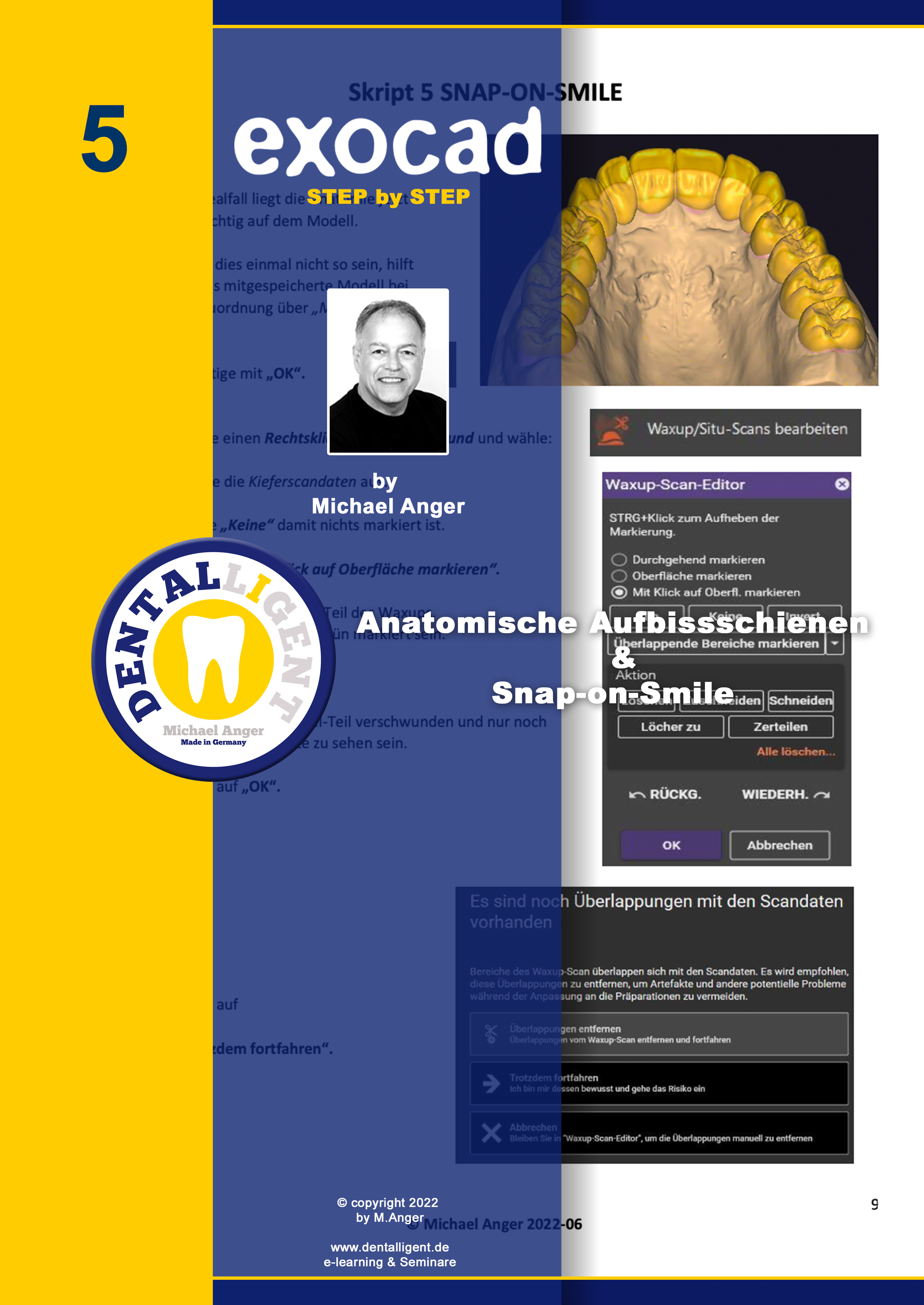 Artikelbild 1 des Artikels “Exocad Step by Step Anleitung -Nr. 5 - Anatomische Aufbissschienen & Snap-on-Smile “