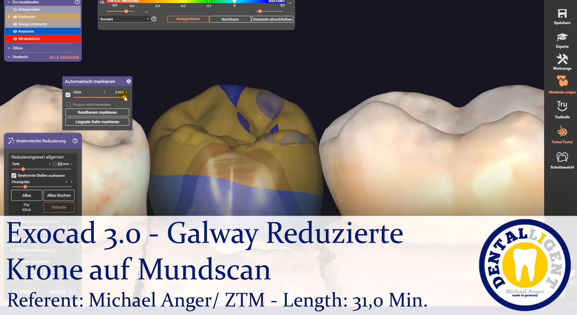 Product image 1 of the product “2021-Exocad 3.0 –  Galway Reduzierte Krone auf Mundscan ”