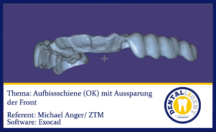 Artikelbild 1 des Artikels “2016-EXOCAD  - Aufbissschiene (OK) mit Aussparung der Front “