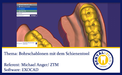Product image 1 of the product “2016-EXOCAD  -Bohrschablonen mit dem Schienentool ”