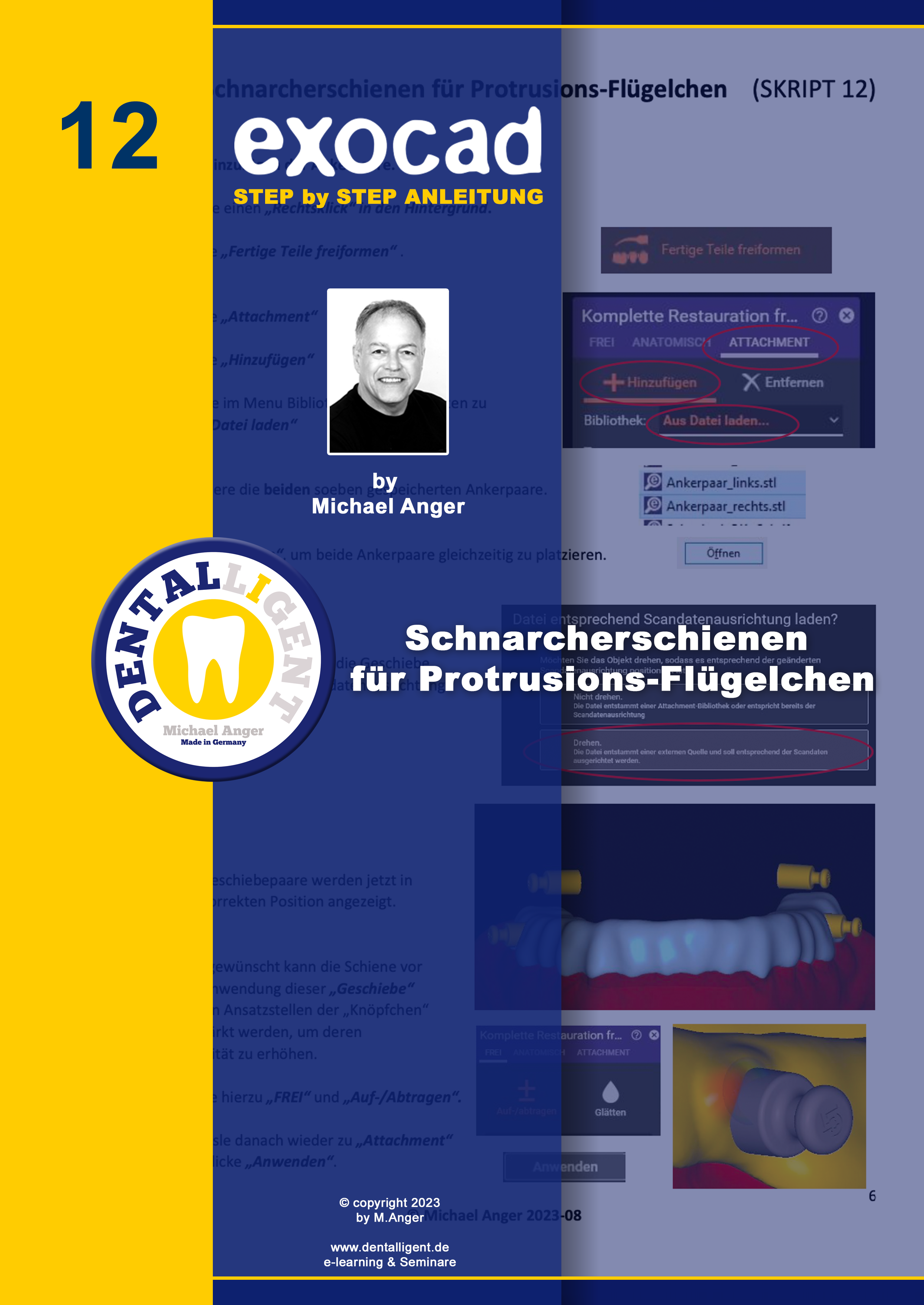 Artikelbild 1 des Artikels “Exocad Step by Step Anleitung - Nr. 12 - Schnarcherschienen für Protrusions-Flügelchen “