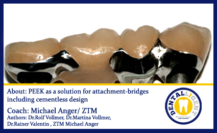 Product image 1 of the product “Free full video - About: PEEK as a solution for attachment-bridges incl. cementless design ”
