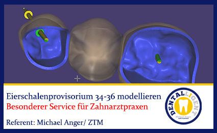 Product image 1 of the product “2017-NEW EXOCAD TUTORIAL  - Eierschalenprovisorium 34-36 modellieren ”