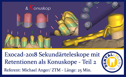 Artikelbild 1 des Artikels “2018-Exocad- Sekundärteleskope mit Retentionen als Konuskope Teil 2 “