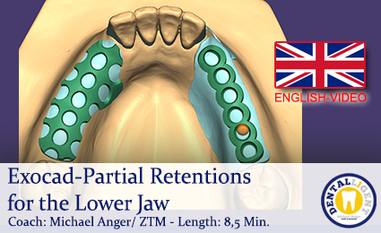 Artikelbild 1 des Artikels “2019-Exocad-Partial Retentions for the Lower Jaw  -ENGLISH “