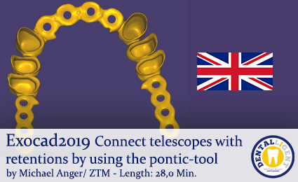 Product image 1 of the product “Exocad2019  - Connect telescopes with retentions by using the pontic-tool ”